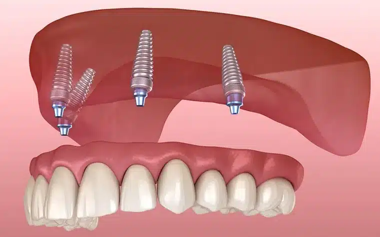 All-on-4 dental implant rendering showing four titanium implants in the upper jaw supporting a full arch of teeth